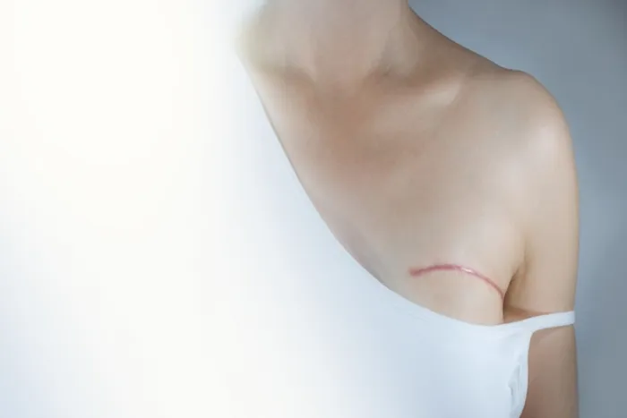 double mastectomy
